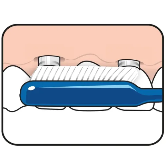 TePe Implant Orthodontic 1 st